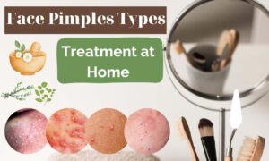 Face Pimples Types and Treatment at Home